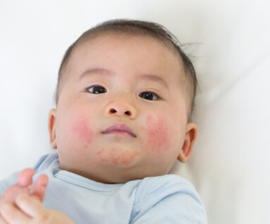 湿疹 鼻炎 こどものアレルギーは専門医のいる小児科へ